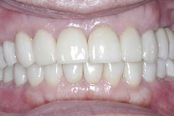 After Cosmetic Dentistry