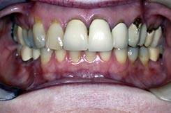 Cosmetic Dentistry Before