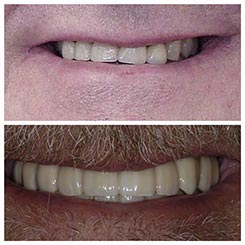 Dental Implant in Auburndale, FL