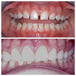 Tooth veneers in Auburndale, FL