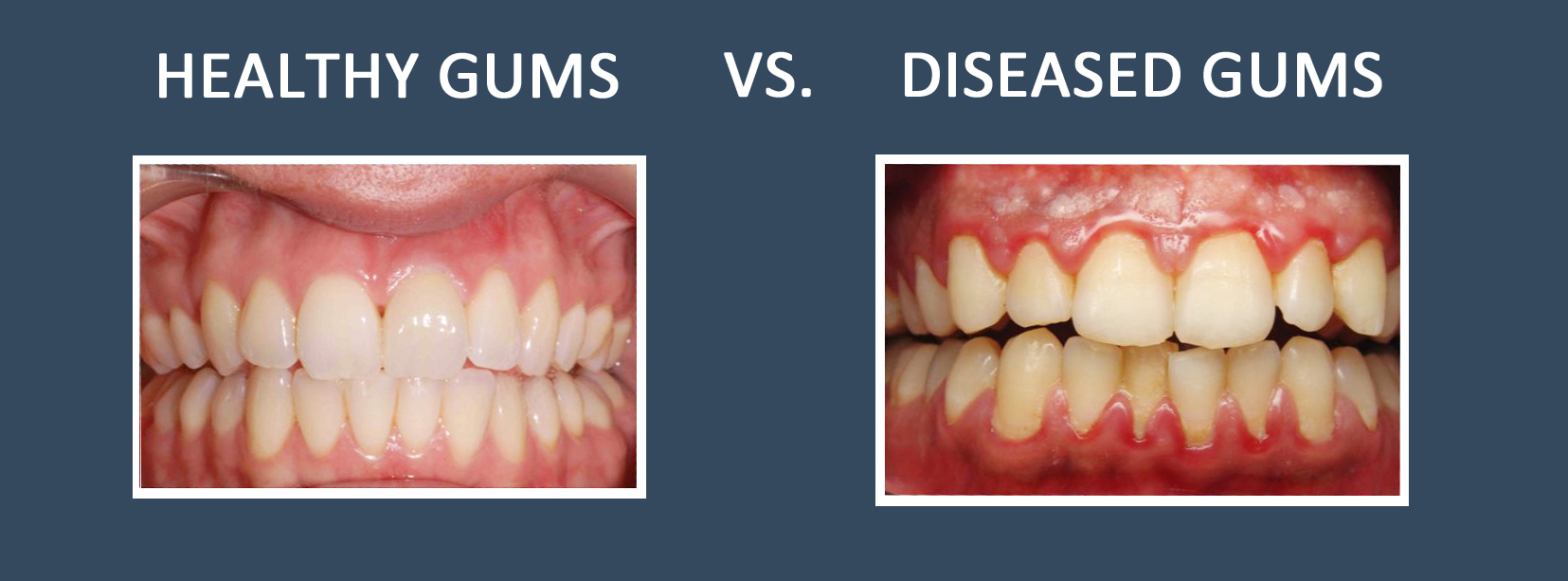 Gum Disease in Auburndale, FL