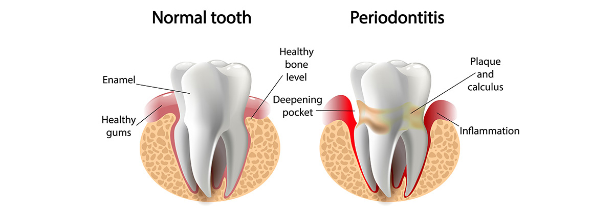 Gum Disease in Auburndale, FL