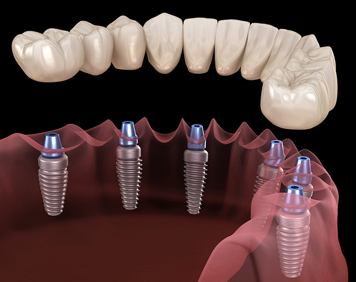 Full Mouth Reconstruction Before