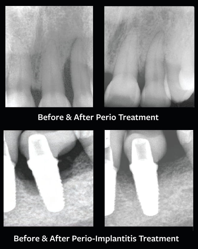 Before And After Implantitis Treatment