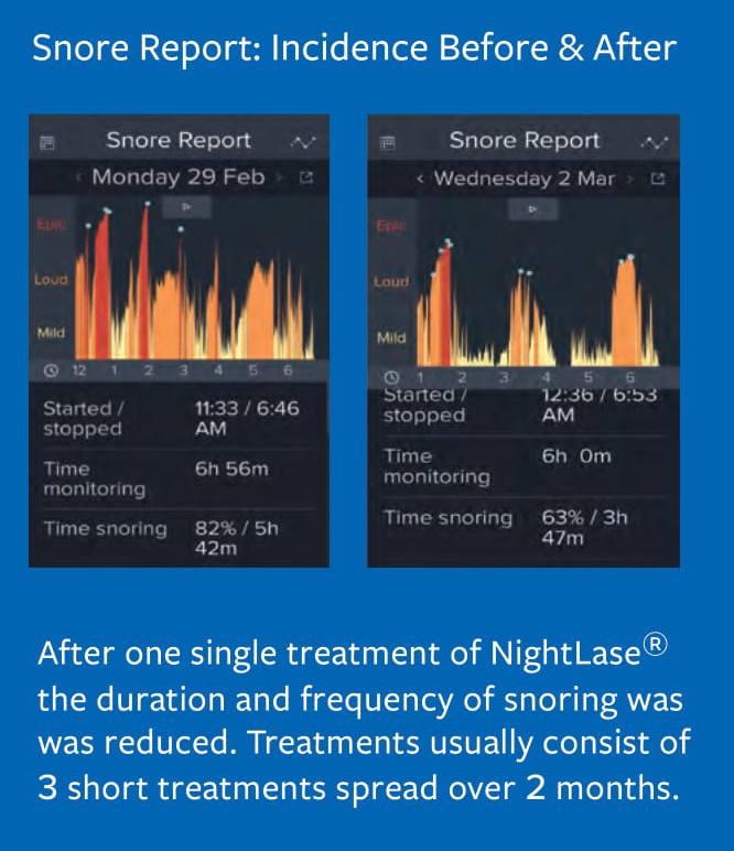 Snore Report