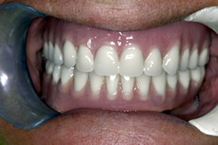 After Full Mouth Reconstruction