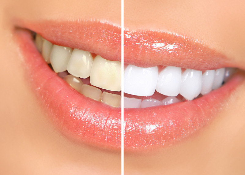 Teeth Whitening Before & After