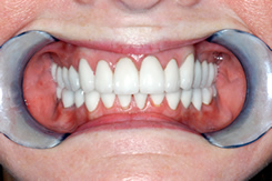 After cosmetic dentistry