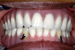 After Dental Implants