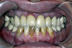 Gum Disease Before Treatment