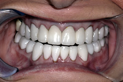 After Gum Disease Treatment