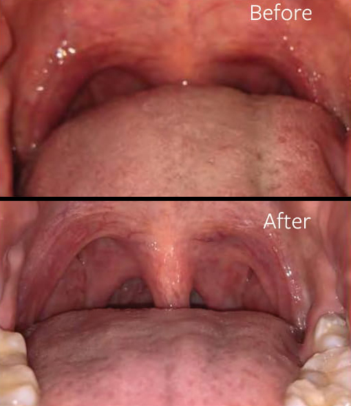 Before and After